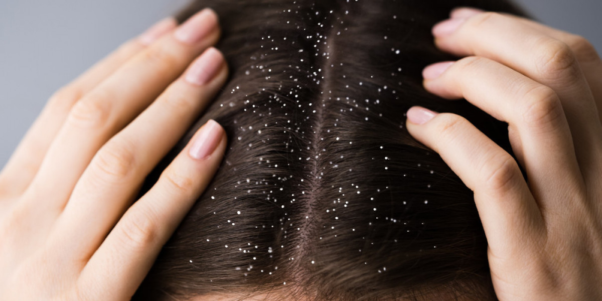 Best Anti-Dandruff Shampoo & Hair Care Guide