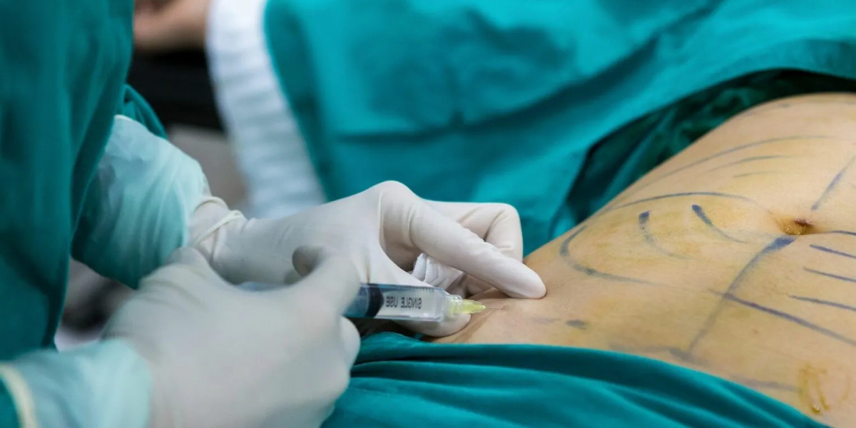 Why Liposuction Remains One of the Most Popular Cosmetic Procedures