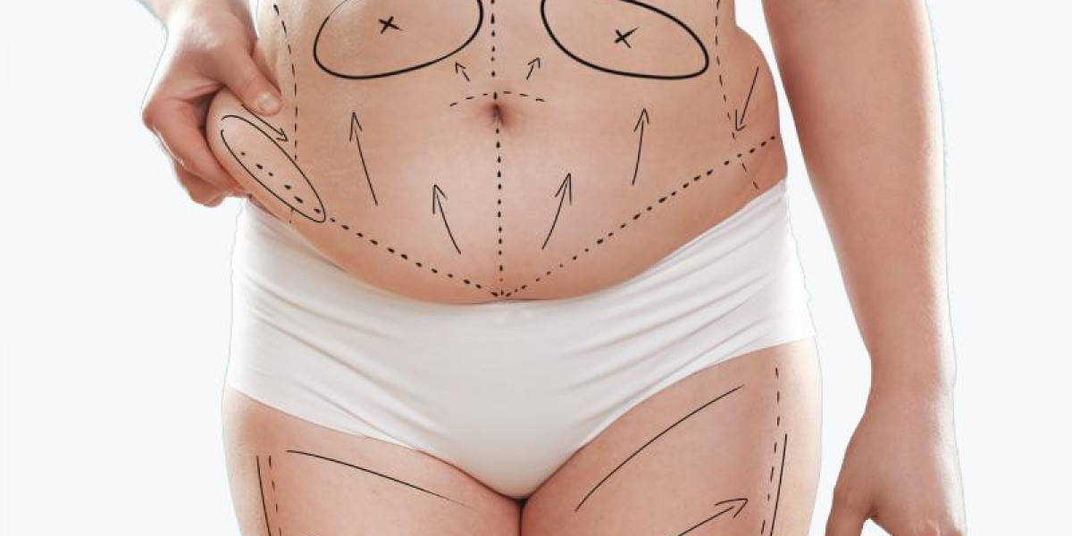 Tummy Tuck Surgery Risks and Complications