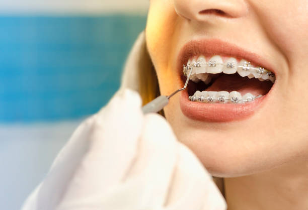 Why Invisalign Is Replacing Braces for Adults Everywhere – Telegraph