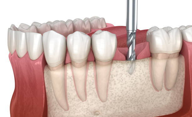 Do You Need Bone Grafting Before Dental Implants? – Telegraph