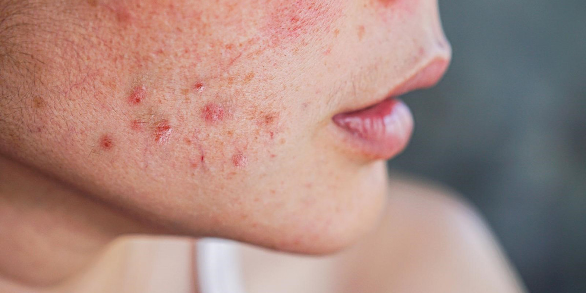 How to Maintain Results After Acne Treatment in Dubai