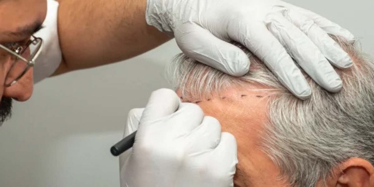 Recovery Experience Following DHI Direct Hair Implant in Dubai