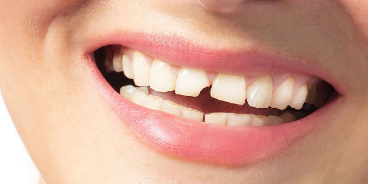 Complete Guide to Repair, Restore, and Protect Teeth Tooth Fracture Treatment in Pakistan: