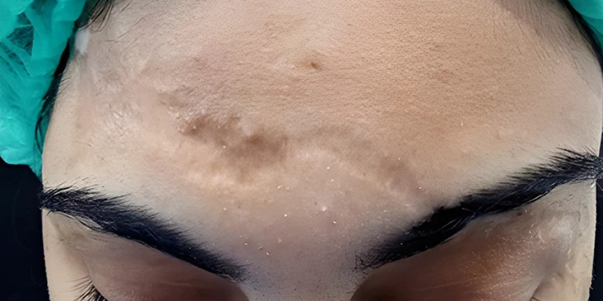 Surgical Scar Revision for Visible Injury Marks