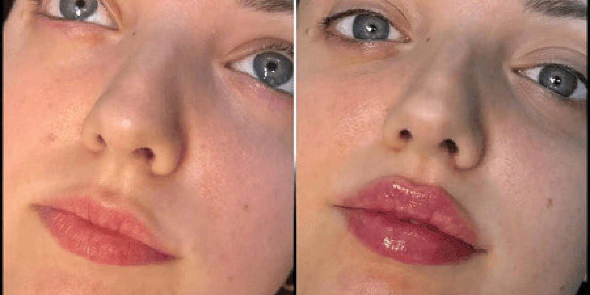 Best Doctors in dubai: Transformative Fillers Results