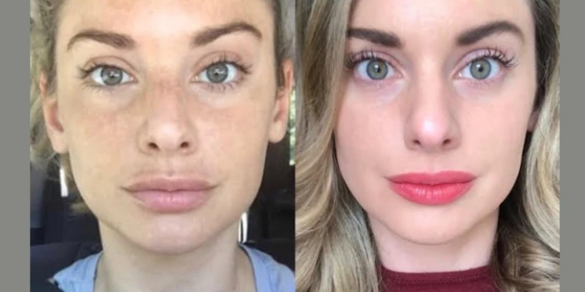 Best Doctors in Dubai for RF Microneedling Skin Solutions